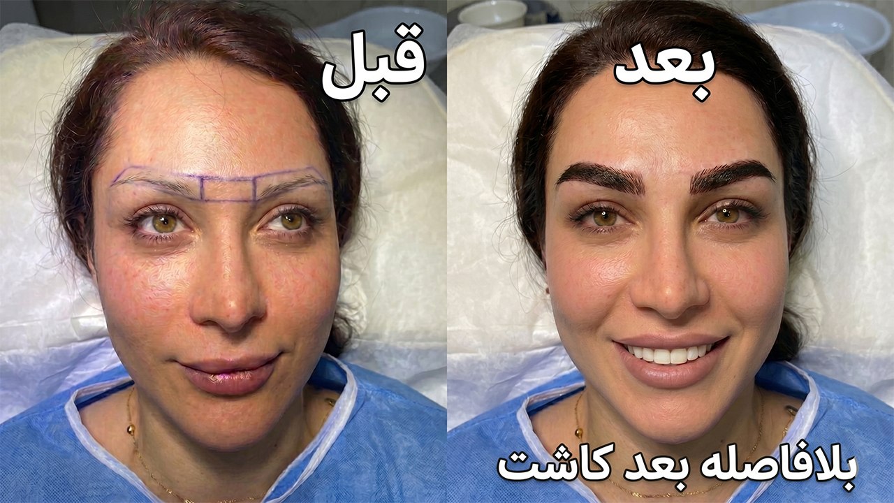 کاشت ابرو و مو /سلبریتی متد🥰